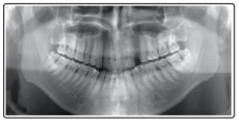 Fulltext | A Rare Case Report Along With Surgical Management of ...